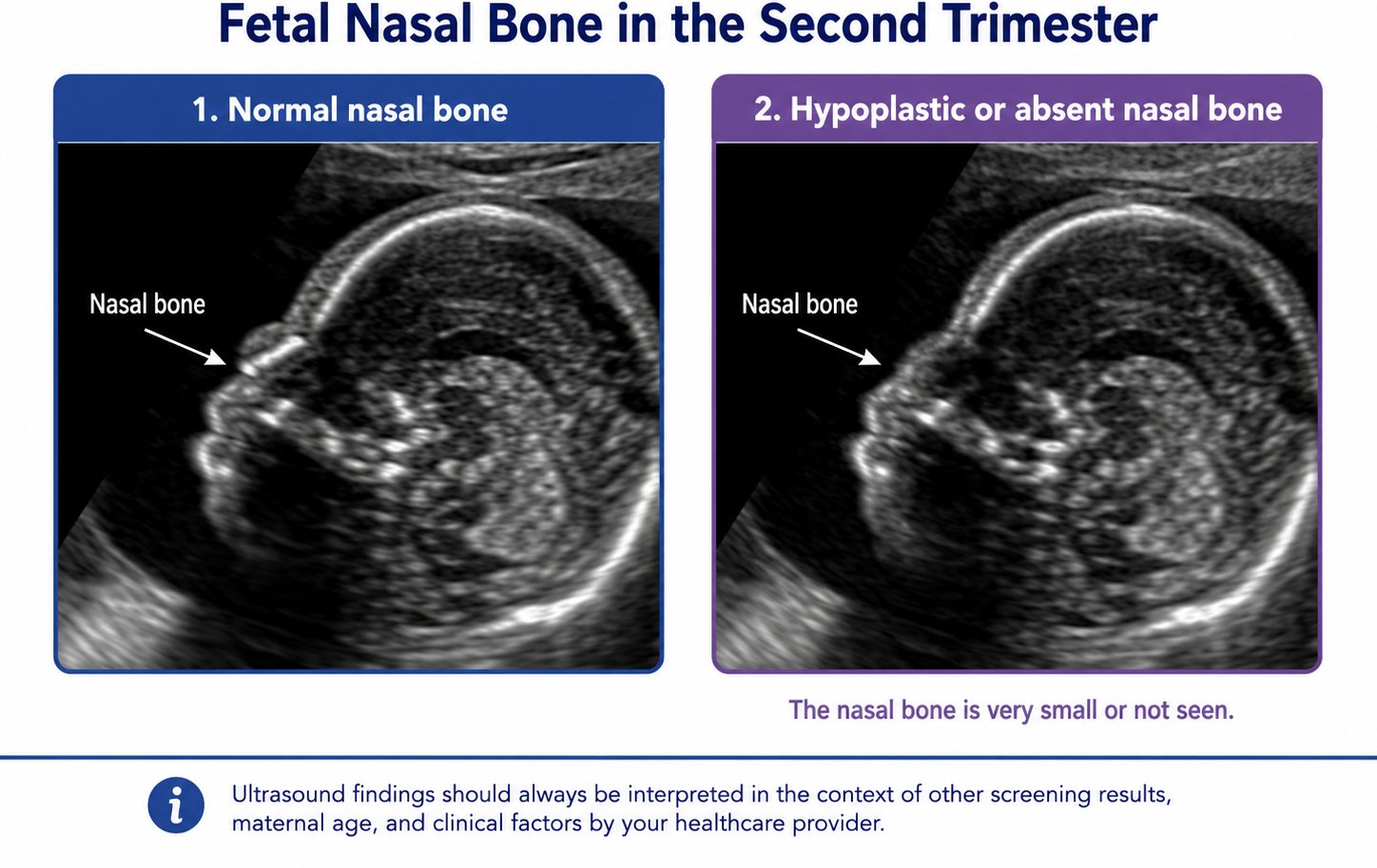 Ultrasound-style comparison showing a normal fetal nasal bone and a hypoplastic or absent fetal nasal bone.